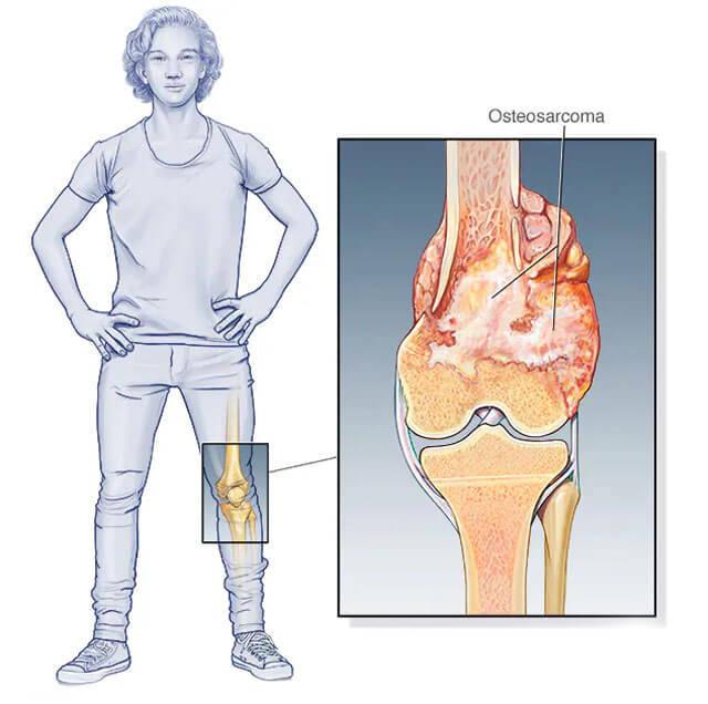 Osteosarkom nedir?