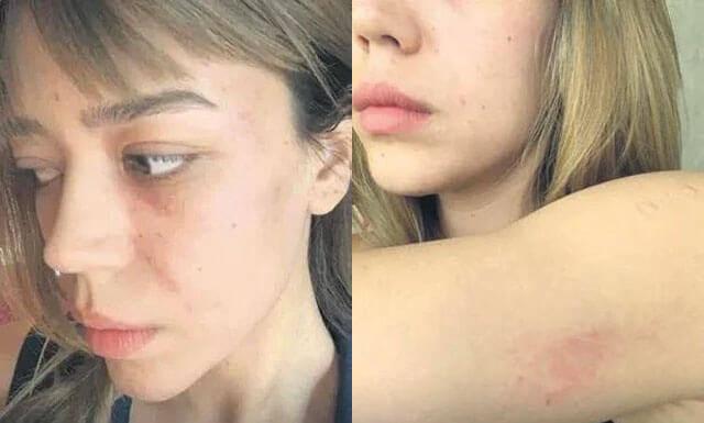 Özcan Deniz'in eski eşi Feyza Aktan'ın darp fotoğrafları