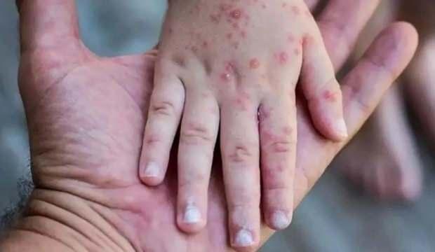 Salgın büyüyor! Bir haftada vakalar yüzde 63 arttı