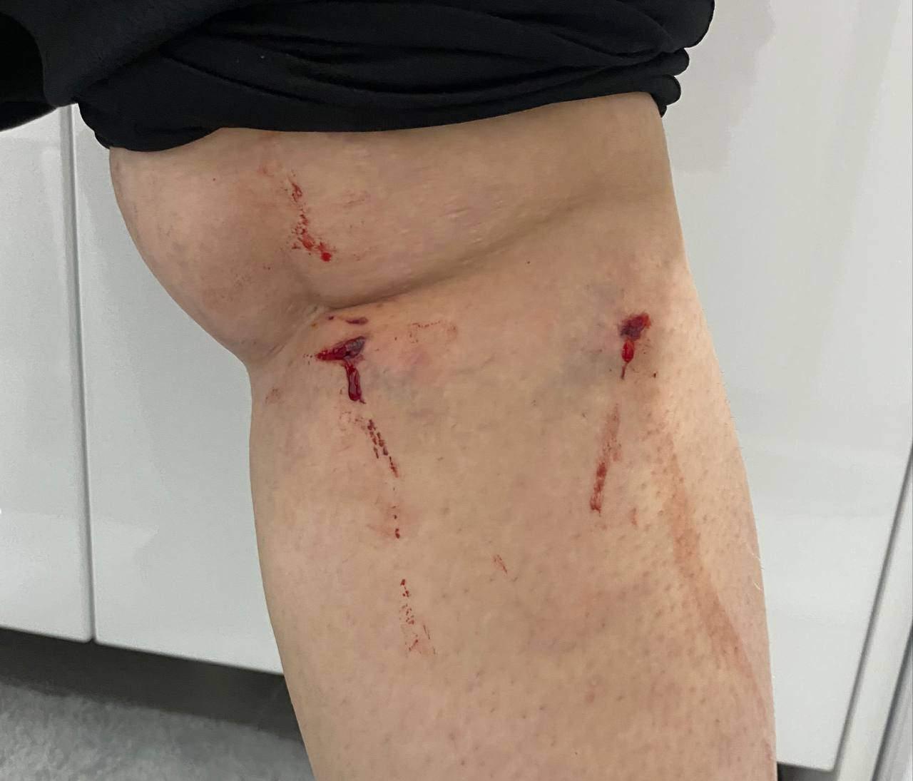 Köpeklerin saldırısına uğrayan öğrencinin bacağı