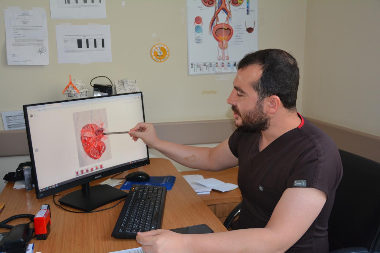 Hastanın böbreğinden 23 santimlik kist çıkarıldı.