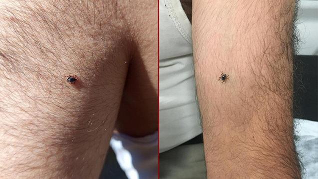 Vücudunun birçok bölgesine kene yapıştığını fark etti. 