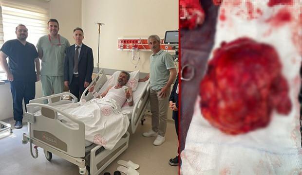 46 yaşındaki adamın böbreğinden çıktı, gören gözlerine inanamadı