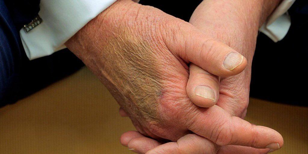Trump'ın hastalığı belirlendi