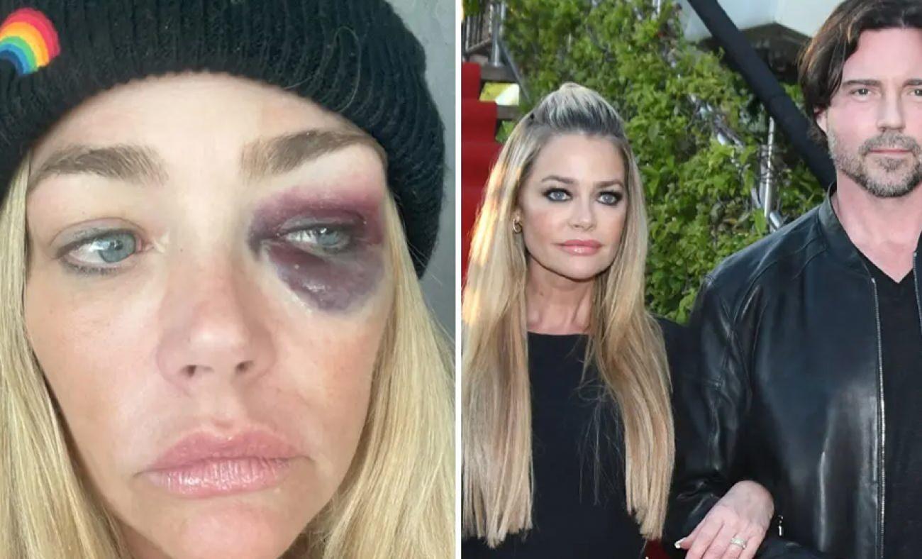 Gözleri mosmor olan Denise Lee Richards'tan eşine ağır suçlamalar: Beni öldürmeye çalıştı