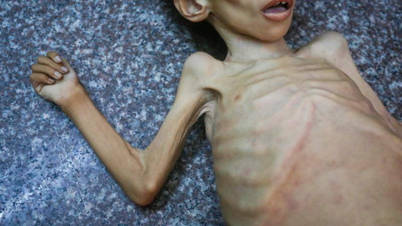 Gazze'de açlıktan ölen 4 yaşındaki Razan Ebu Zaher