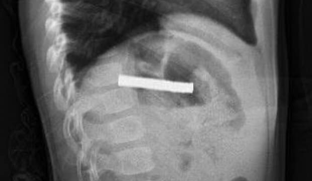 Anne babalar dikkat! 3 yaşındaki çocuğun boğazından çıkarıldı: Tam 19 tane