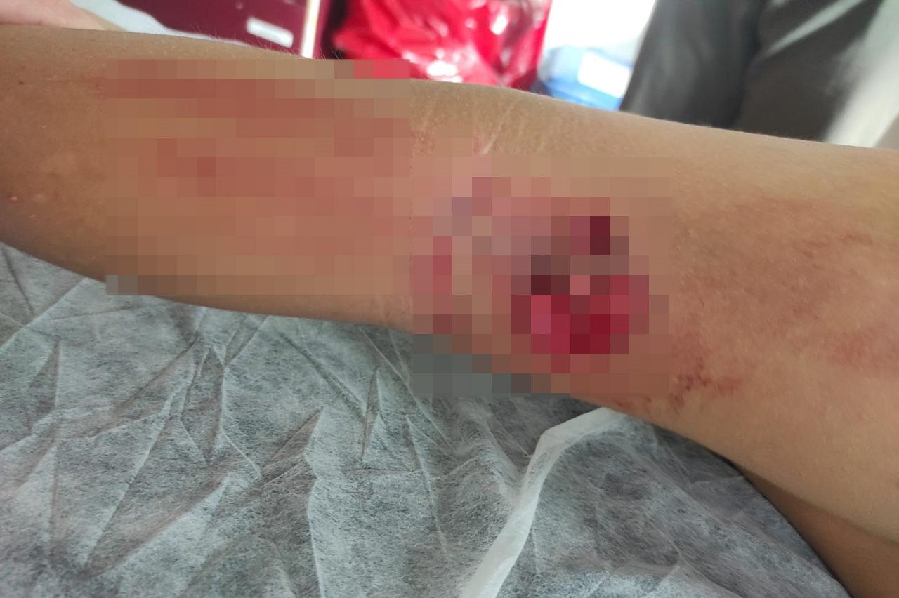 Başıboş sokak köpeği İ.A. isimli çocuğun bacağını parçaladı. 