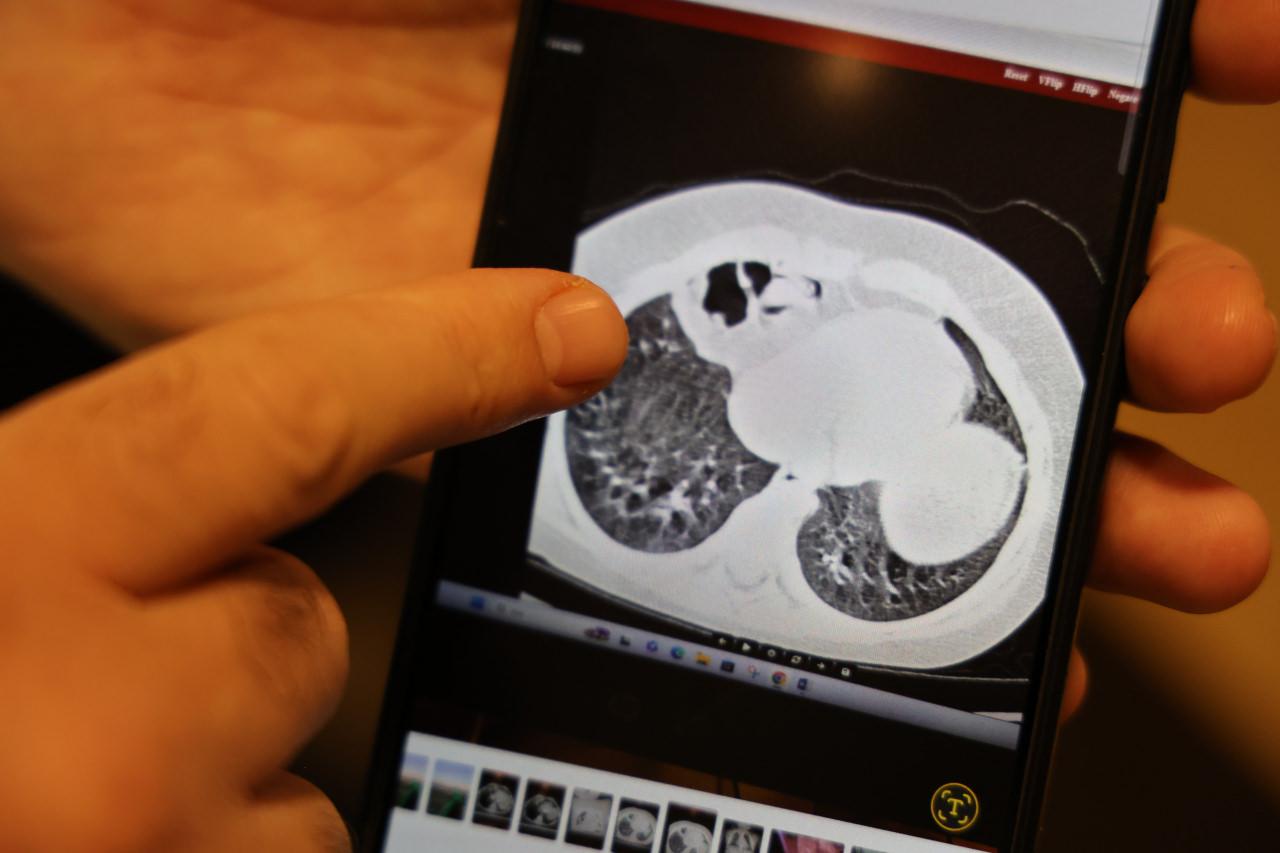 Bağırsakları, göğüs boşluğuna çıktı.