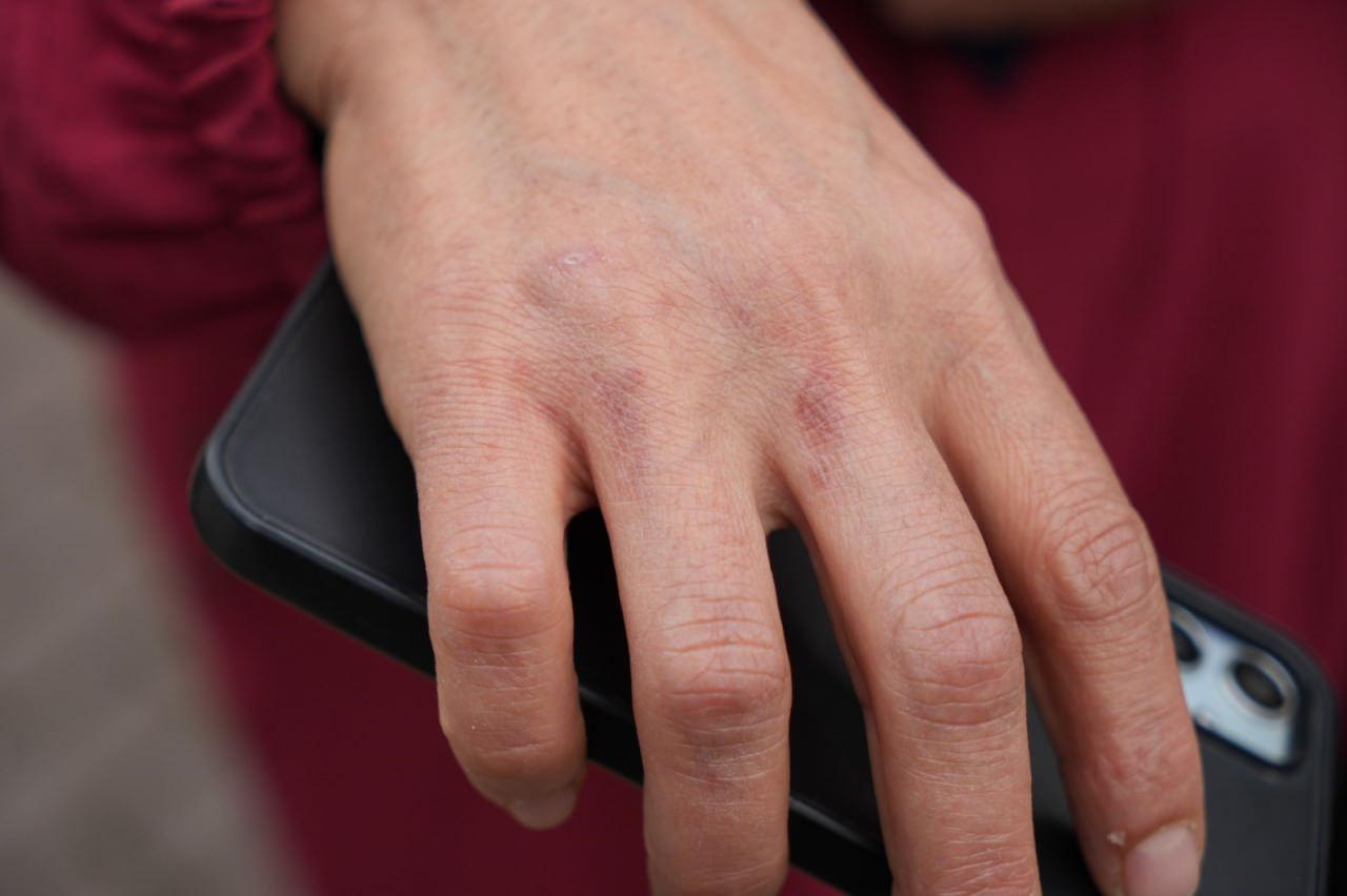 Aras'ın elleri yandı.