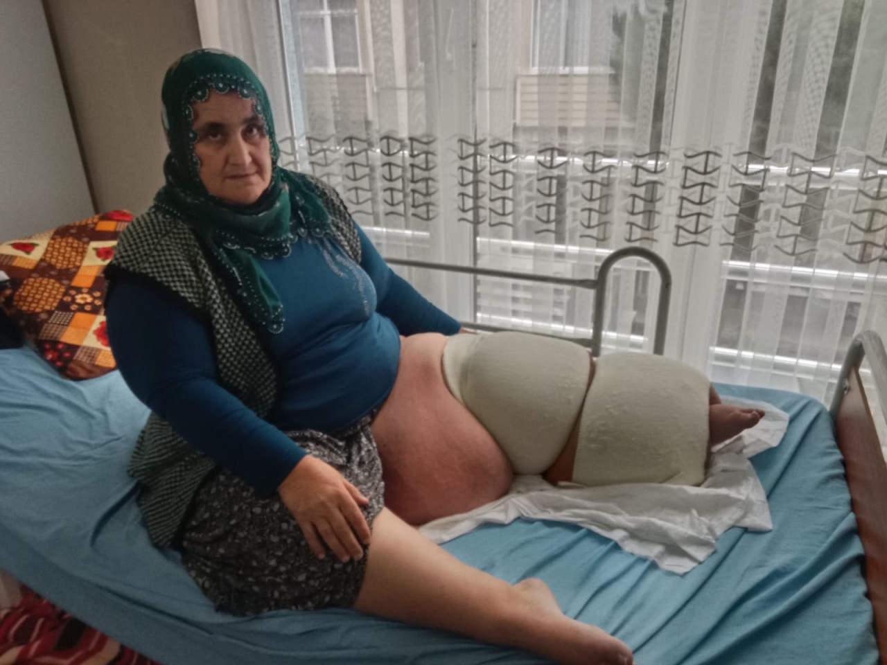Cennet Karabacak (53), 35 yıldır fil hastalığıyla mücadele ediyor.