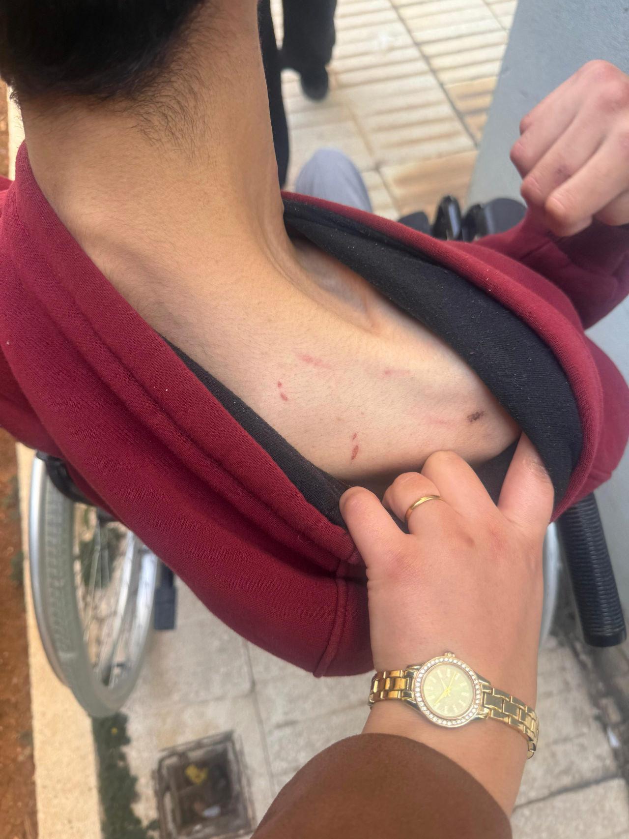 Furkan Kaya'nın vücudundaki darp izleri.