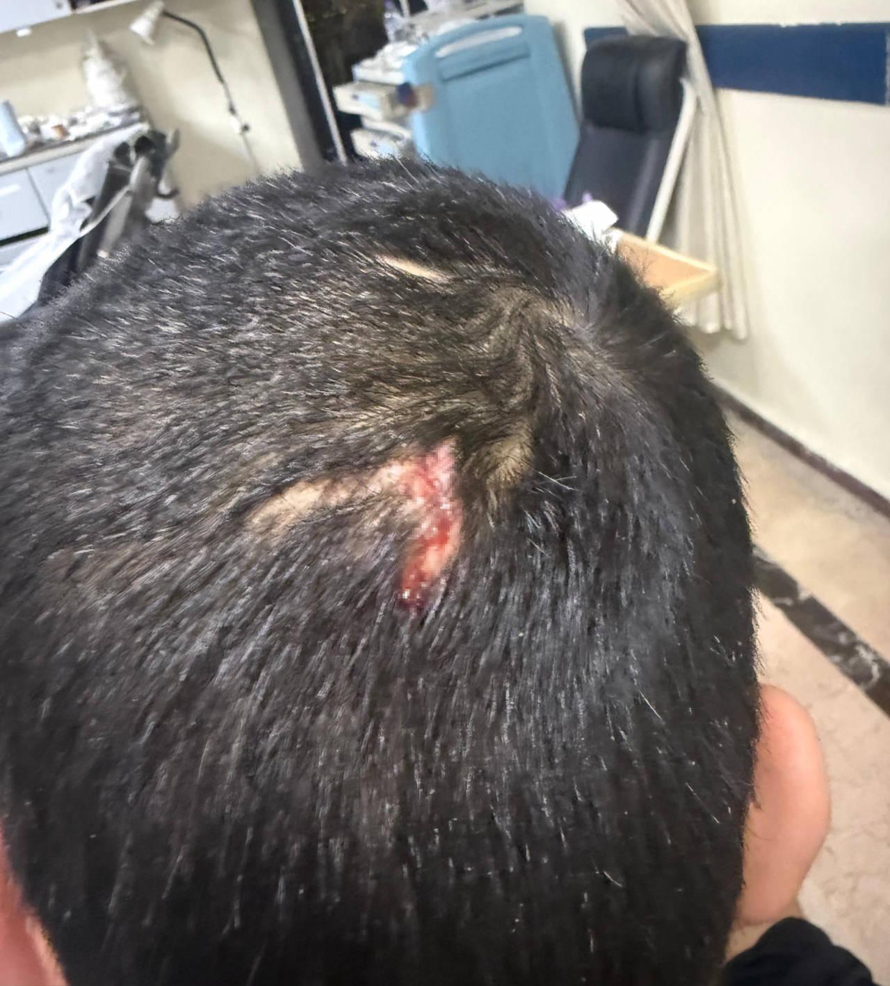 Furkan Kaya'nın başına altı dikiş atıldı. 