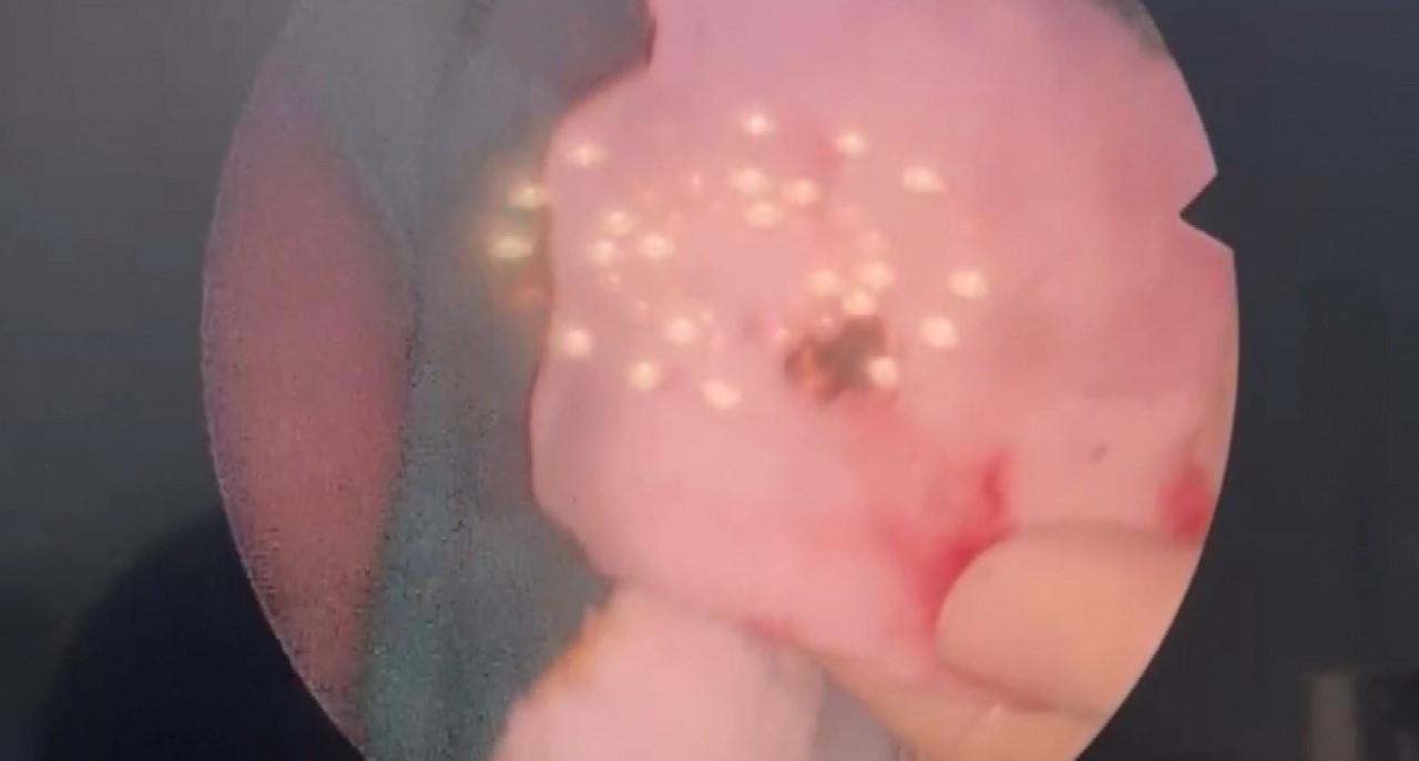 Hastanın burnunda taş tespit edildi