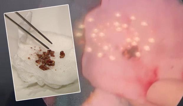 Yıllarca fark edilmedi, estetik ameliyatta ortaya &ccedil;ıktı: Burunda rinolit şoku!