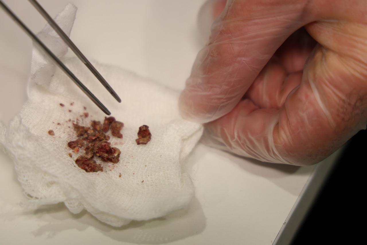 Burundan çıkarılan yabancı cisimler