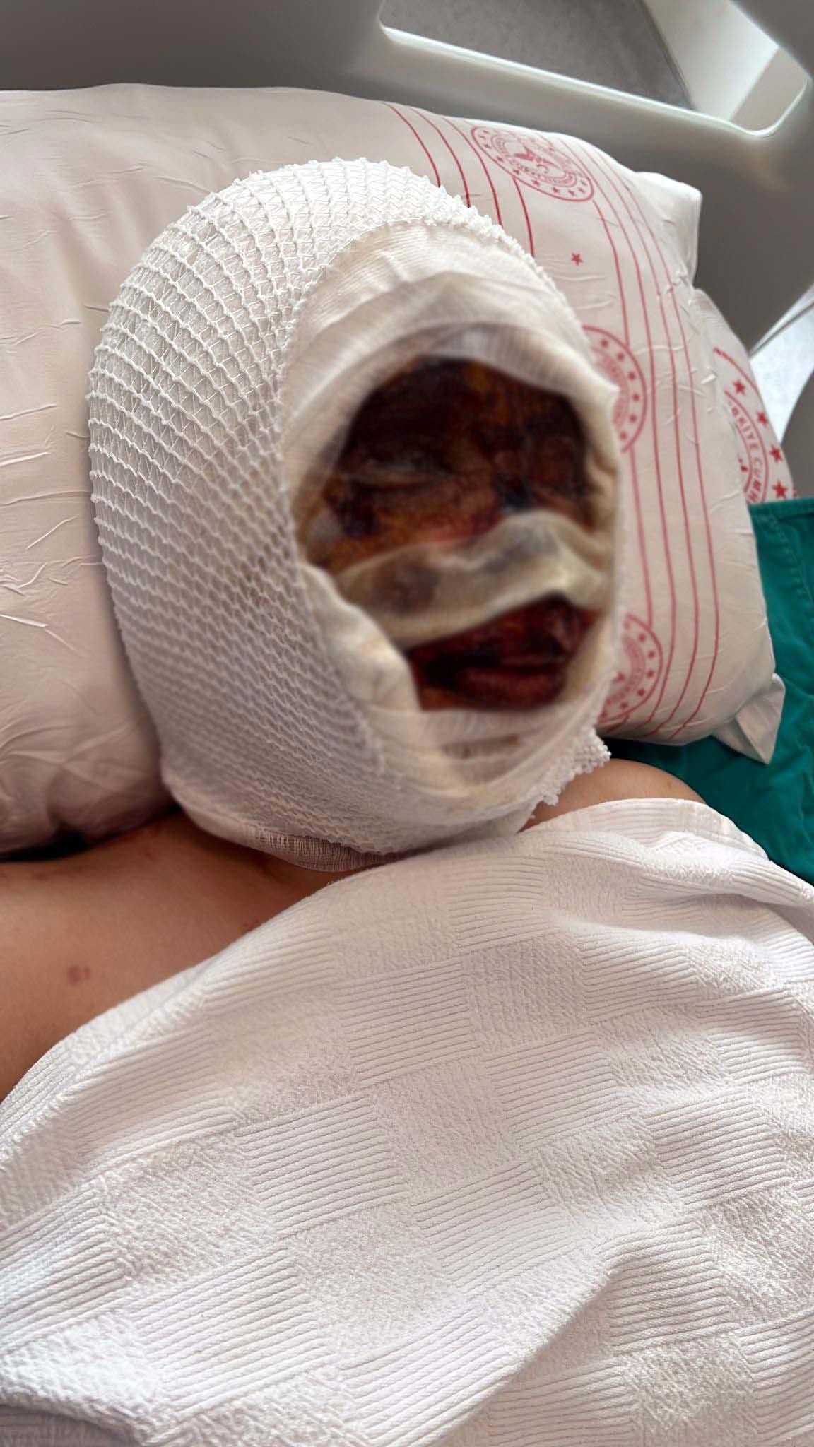 Başından aşağı kezzap döktü.