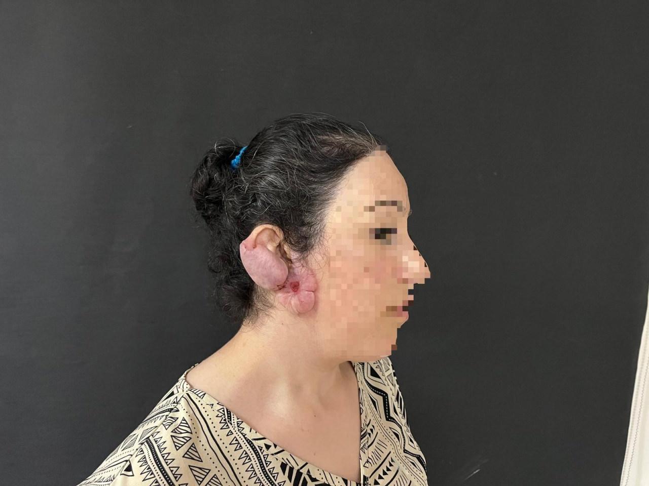 Yıllar içinde büyüyen ileri derecede kulak keloidi.