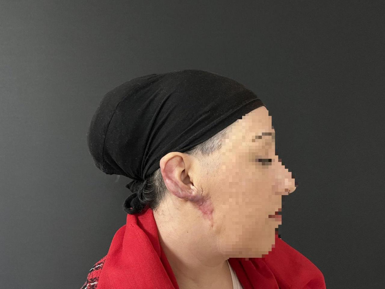 Keloid doku tamamen temizlenirken, kulağın doğal görünümünün korunmasına özen gösterildi. 