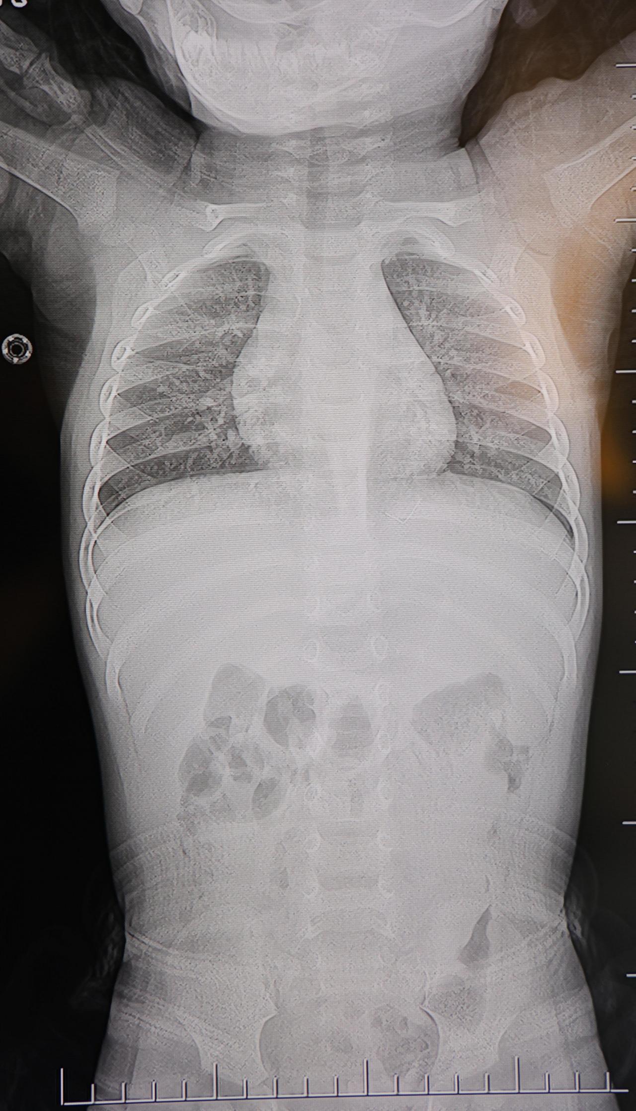 2 santimetre uzunluğunda metal tel bulundu