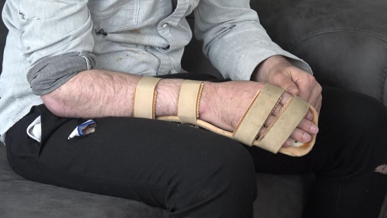 Tabbas, 1 yıllık tedavinin ardından yüzde 76 oranında bedensel engelli kaldı.