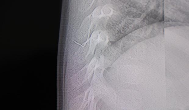 Sırt &uuml;st&uuml; yatınca ağlıyordu! 1 yaşındaki bebeğin v&uuml;cudundan &ccedil;ıkan cisim şoke etti