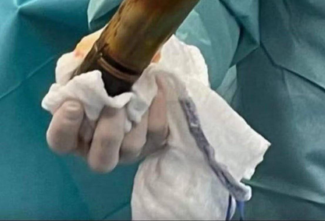 Fransa'da karın ağrısıyla acil servise gelen 80 yaşındaki hastanın bağırsağında Birinci Dünya Savaşından kalma bir patlayıcı tespit edildi. Hasta, bomba imha ekipleriyle birlikte yürütülen bir güvenlik operasyonu ile ameliyat edildi.