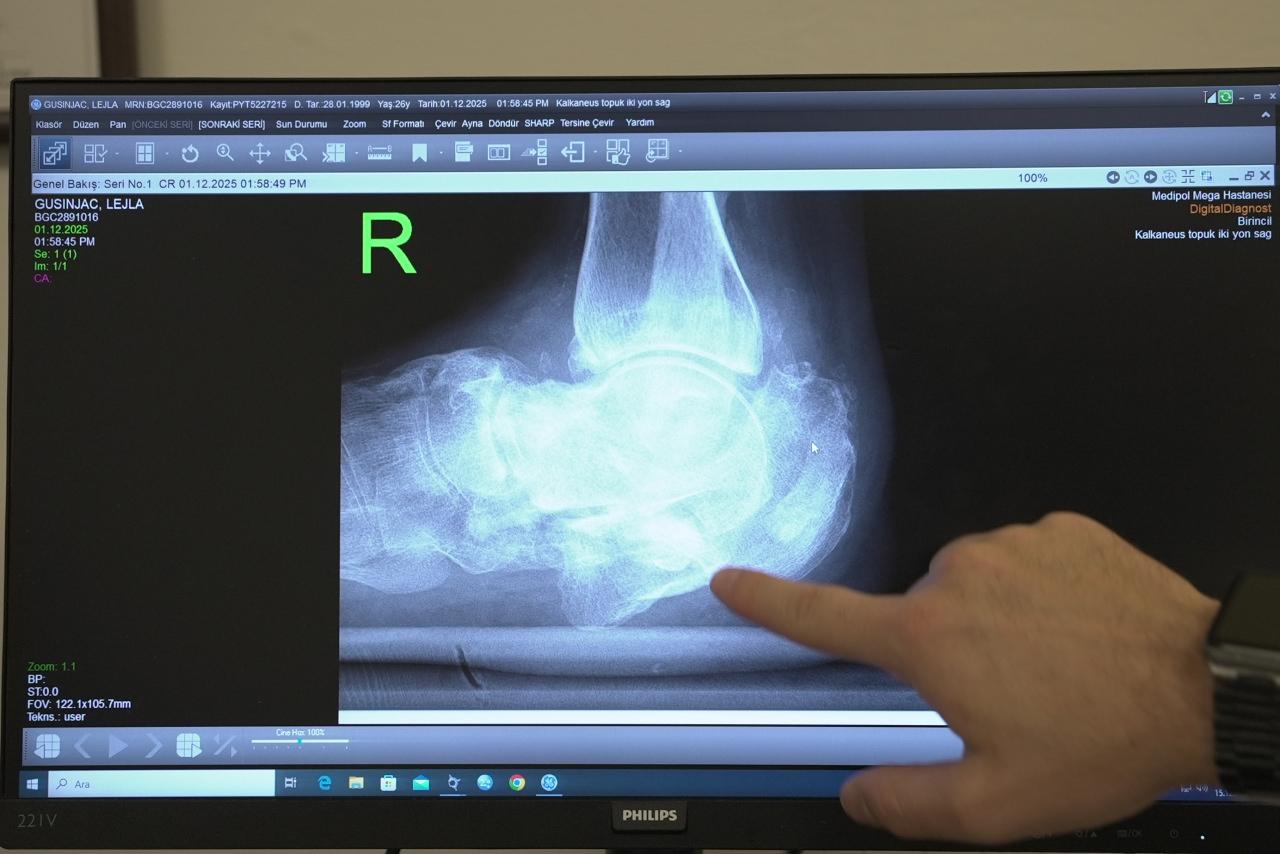Lejla Gusinjac (269 bacağının radyoloji görüntüsü.