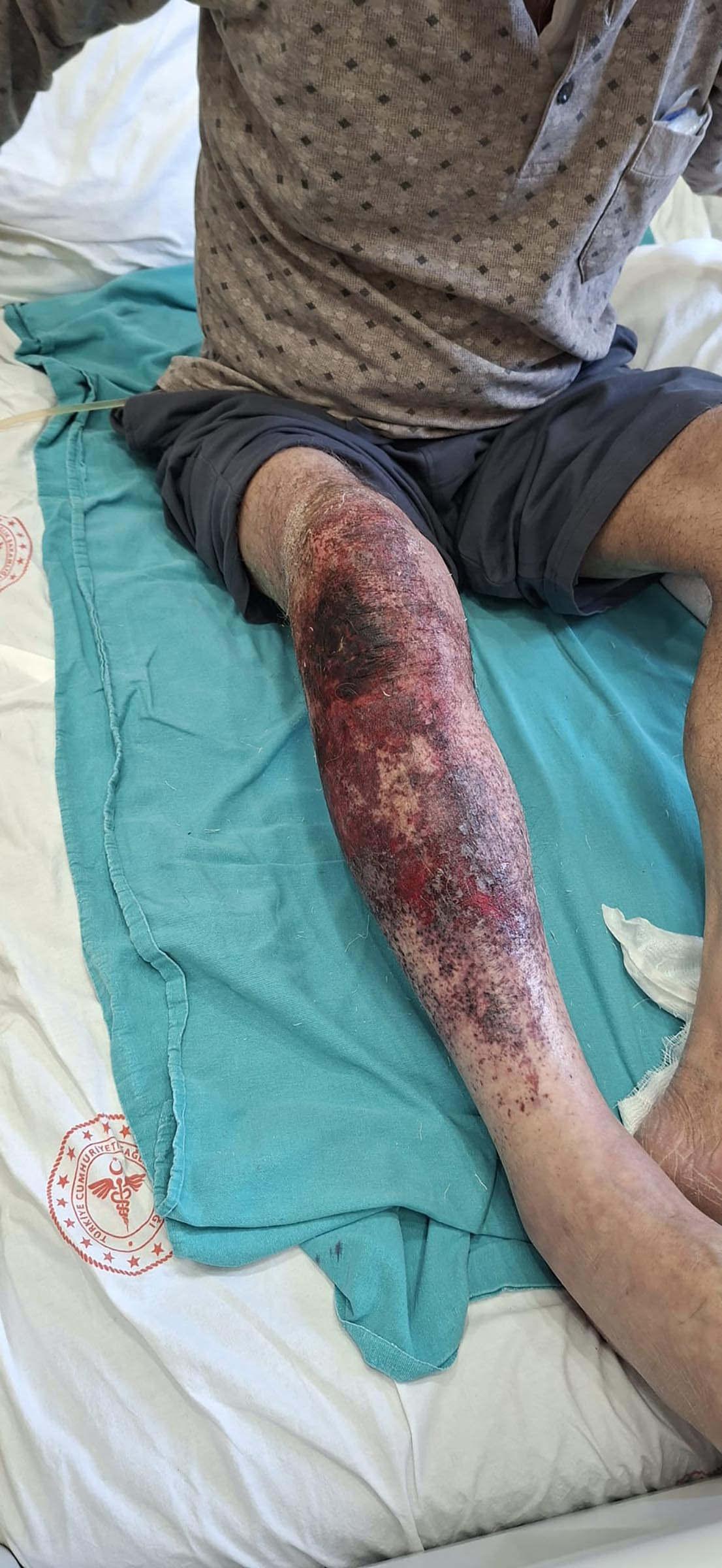 Halis Uca (79), tıkanan lavaboyu açmak isterken kimyasal madde ile bağını yaktı.