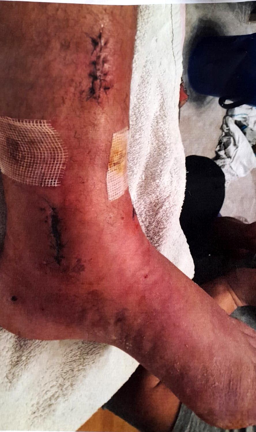  Yunus Güray (60) geçirdiği kazanın ardından 6 ameliyat geçirdi. 