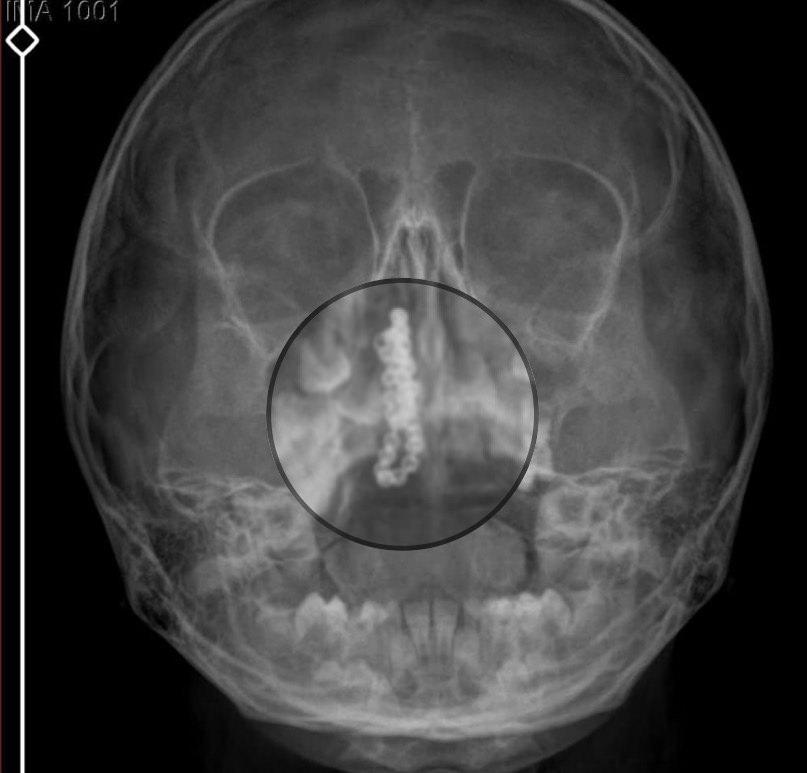 Zincir ameliyat ile çıkartıldı. 