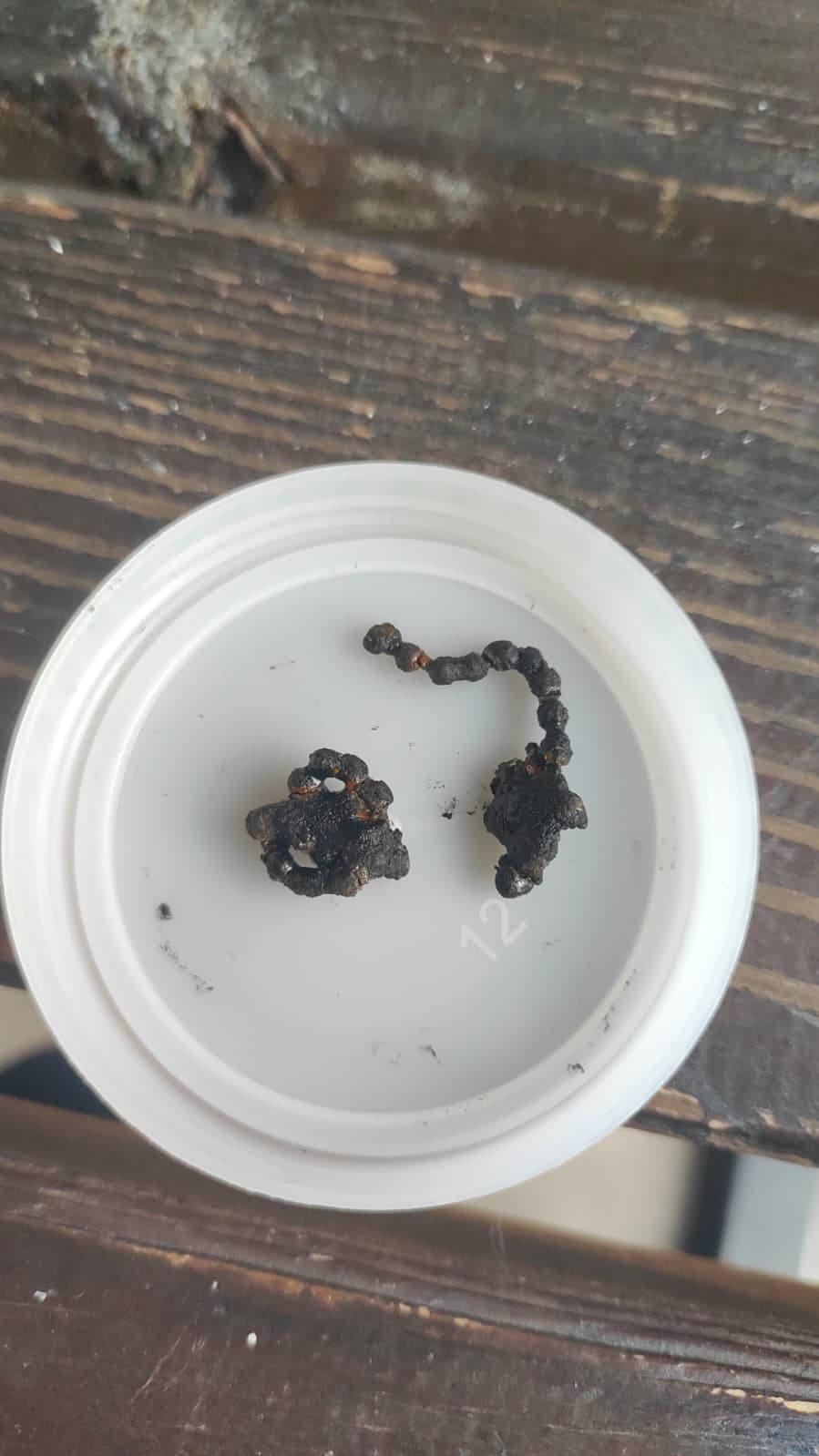  Polen Tekin'in (5) burnundan çıkan zincir. 