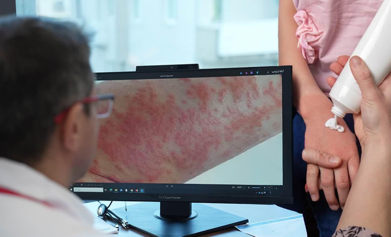 Uzman isim uyardı: Egzaması olan &ccedil;ocuklarda gereksiz diyet alerjiyi tetikleyebilir