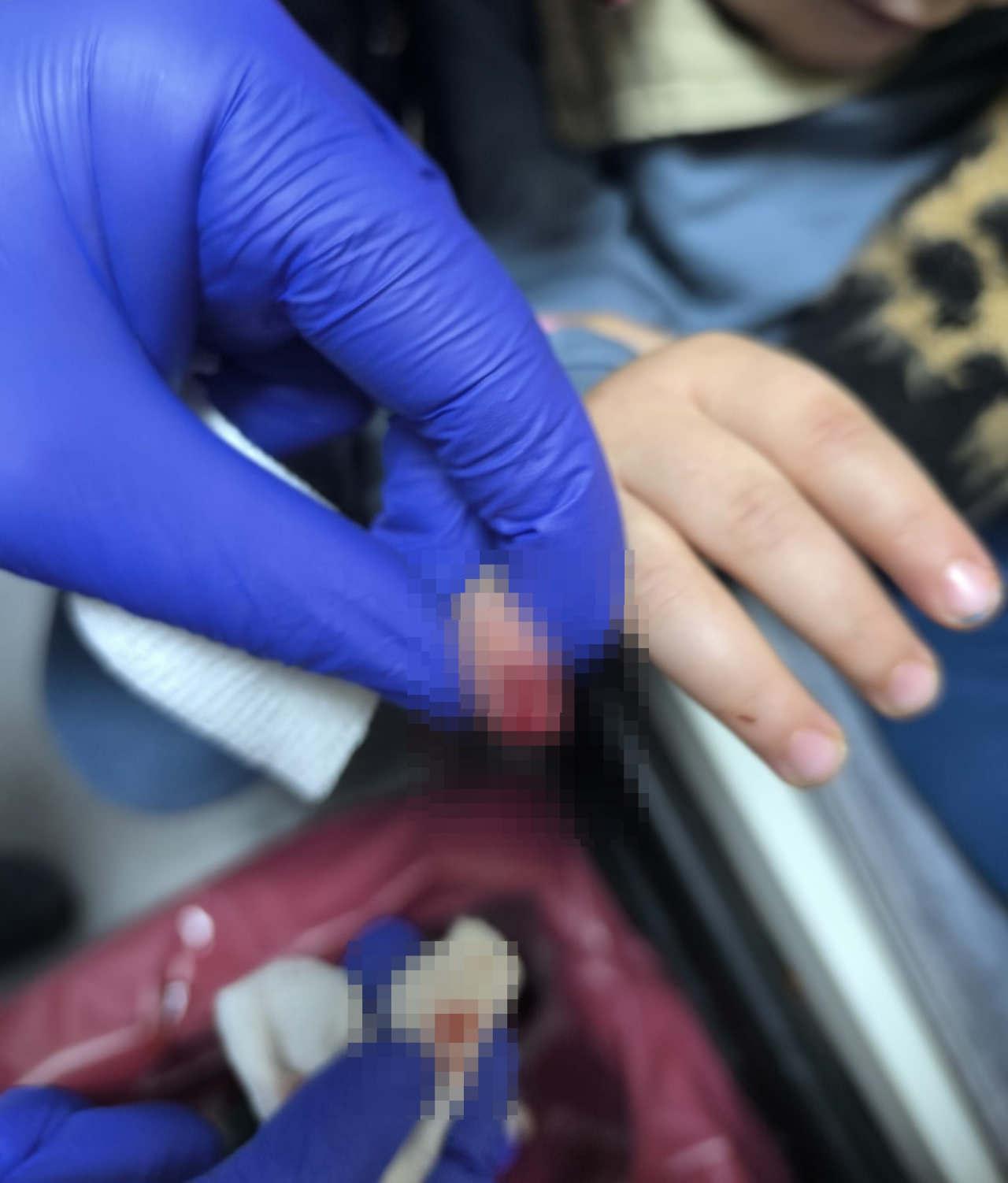 3 yaşındaki T.B.'nin parmağı koptu.