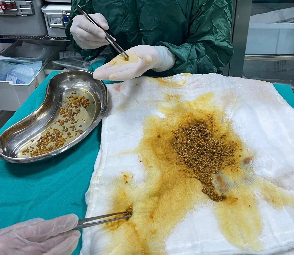 Hastadan toplamda 2 bin 67 taş çıkartıldı. 