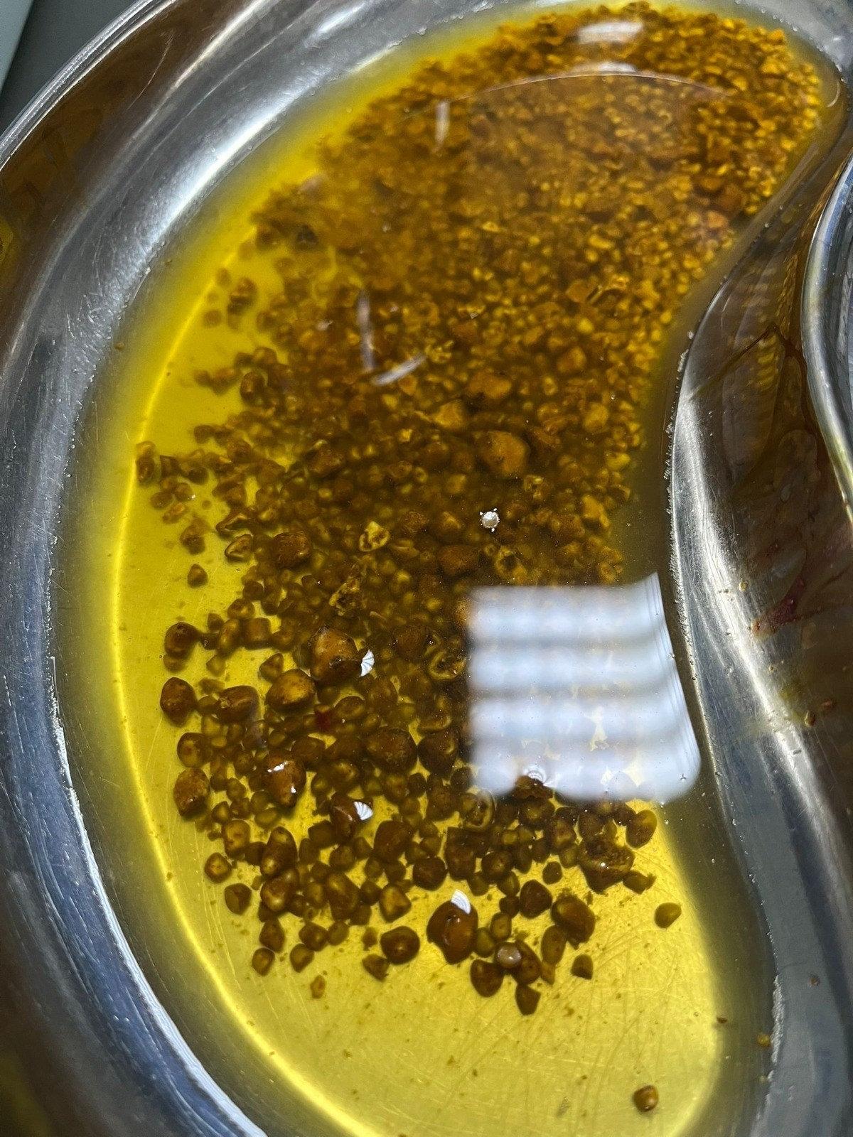 Hastadan çıkan taşlar. 