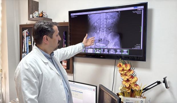 İdrar kanalından &ccedil;ıkan taşlar doktor, hasta ve yakınlarını şaşırttı