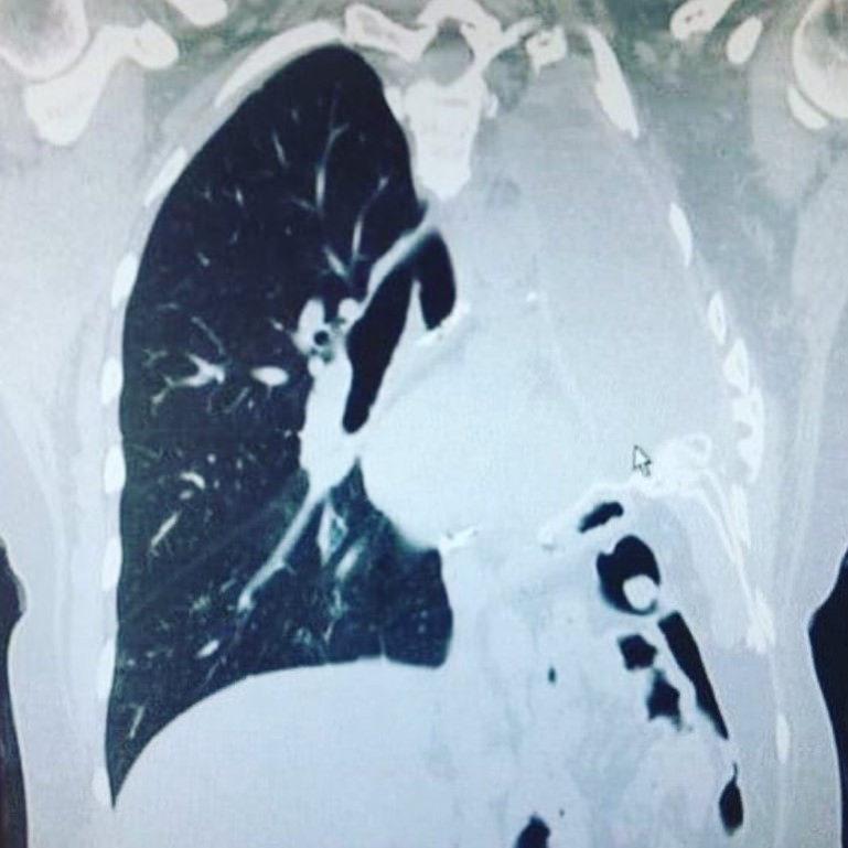 Kadının akciğer tomografisi