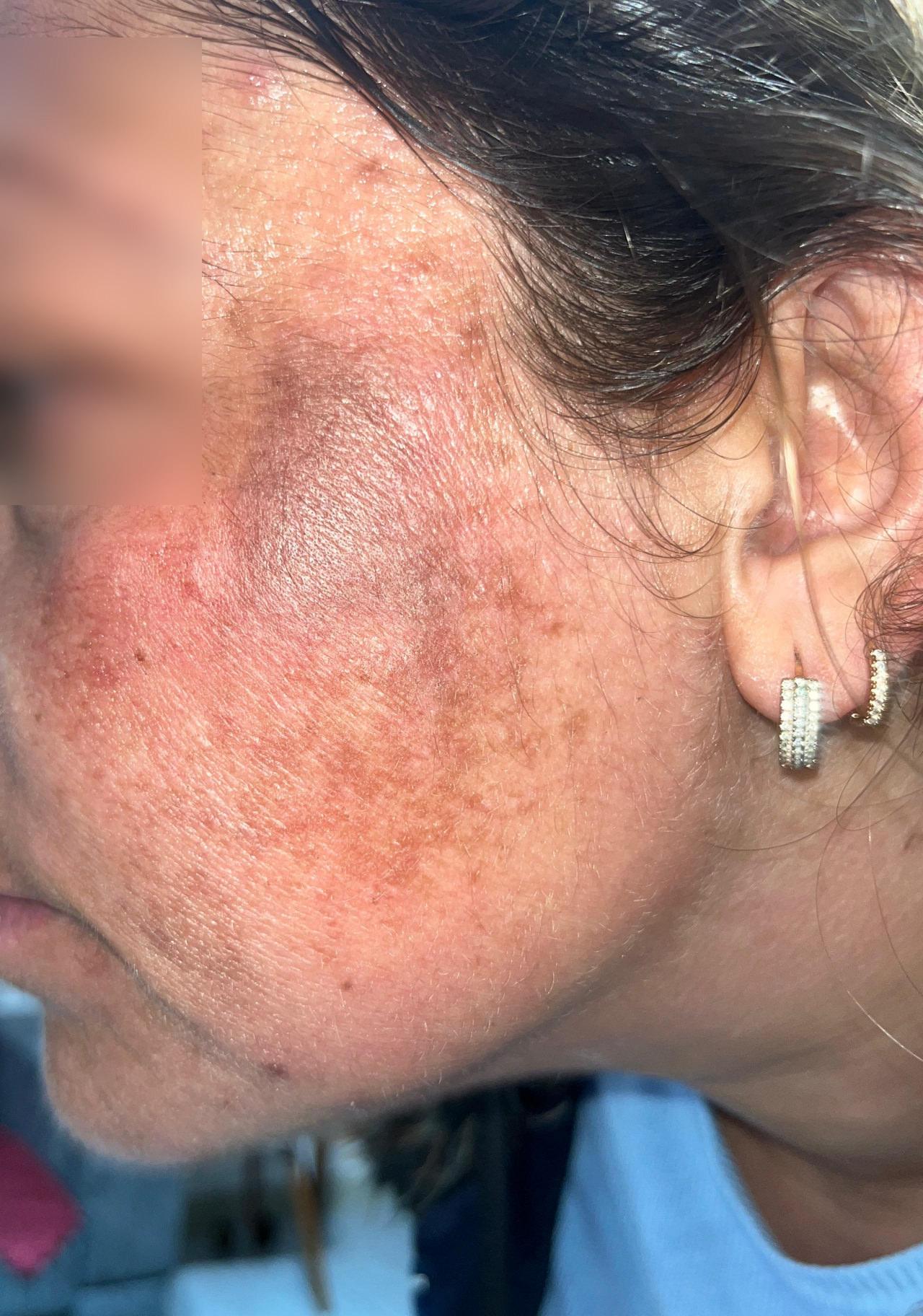 Saide G. (40) isimli kadının yüzünde ikinci derece yanıklar oluştu.