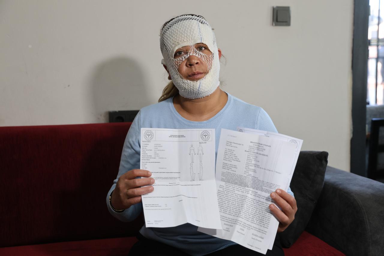  Güzelleşmek uğruna gittiği merkezde yüzü yandı.