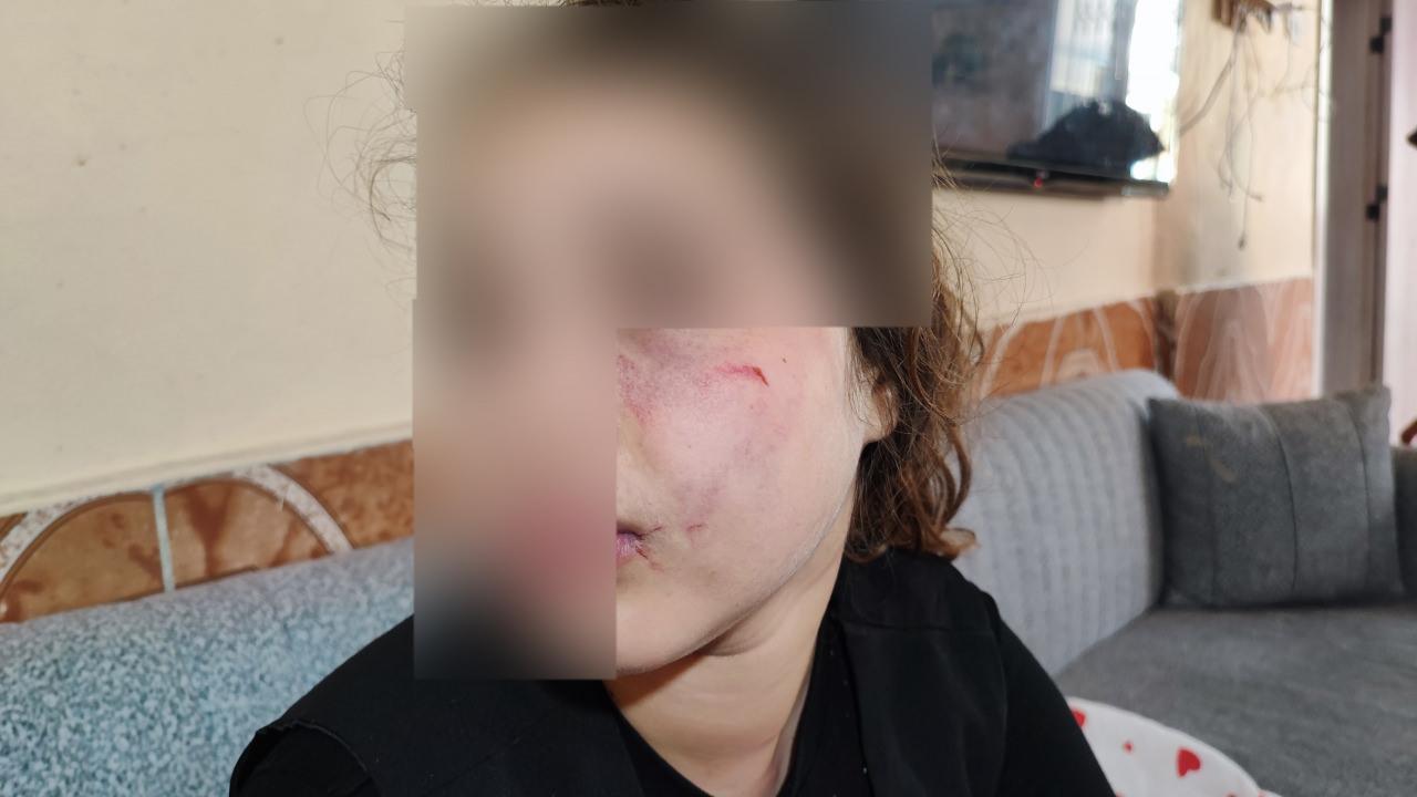 11 yaşındaki çocuğun yüzü tanınmaz hale geldi. 