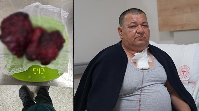  İrfan Bozan (54), isimli hasta ve boynundan çıkartılan kitle. 