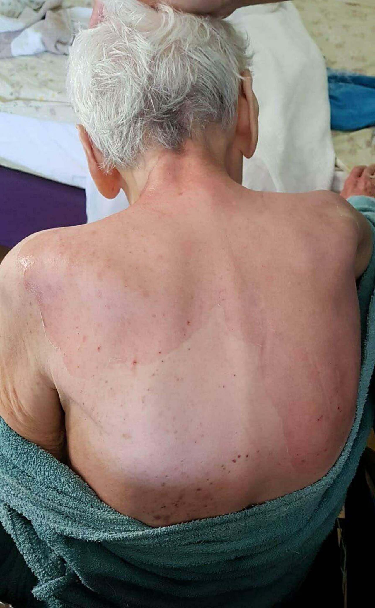 Fatma Uraz'ın (86) sırtında yanıklar oluştu.