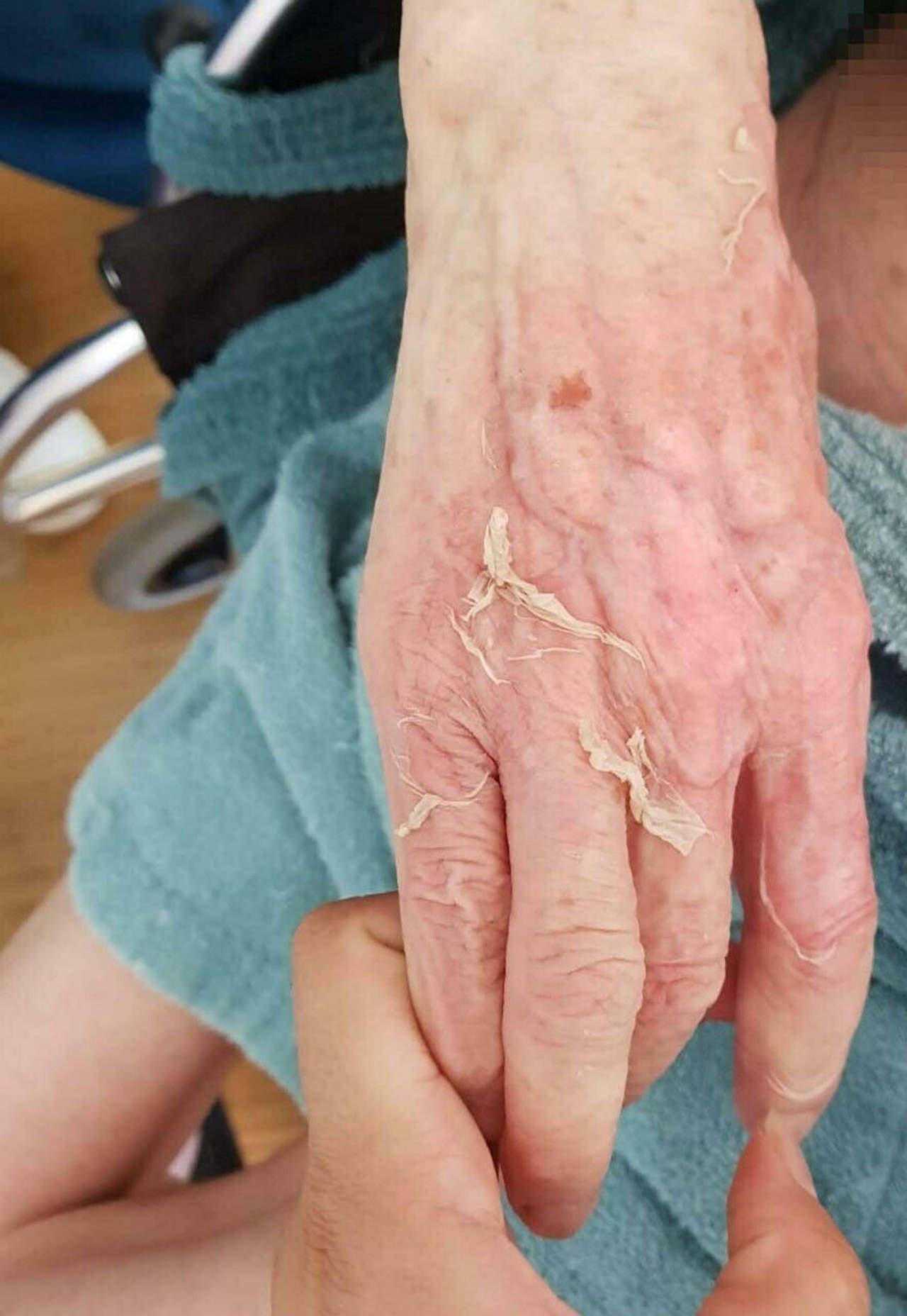Fatma Uraz'ın (86) banyo sonrası ellerinin son hali. 
