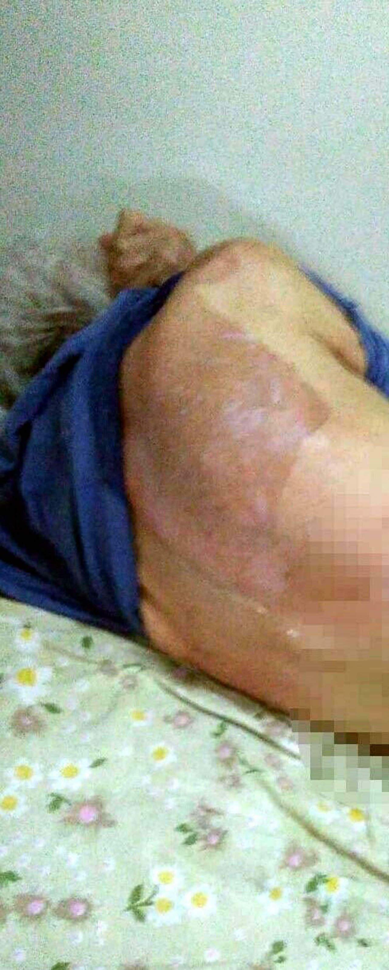 Fatma Uraz'ın (86) vücudunda oluşan yanıklar. 