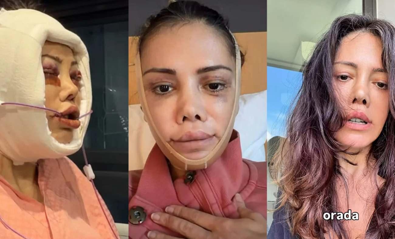Y&uuml;z nakli ge&ccedil;iren Didem Ceran ateş p&uuml;sk&uuml;rd&uuml;: 'İnsanlar neden yaraya tuz basar?'