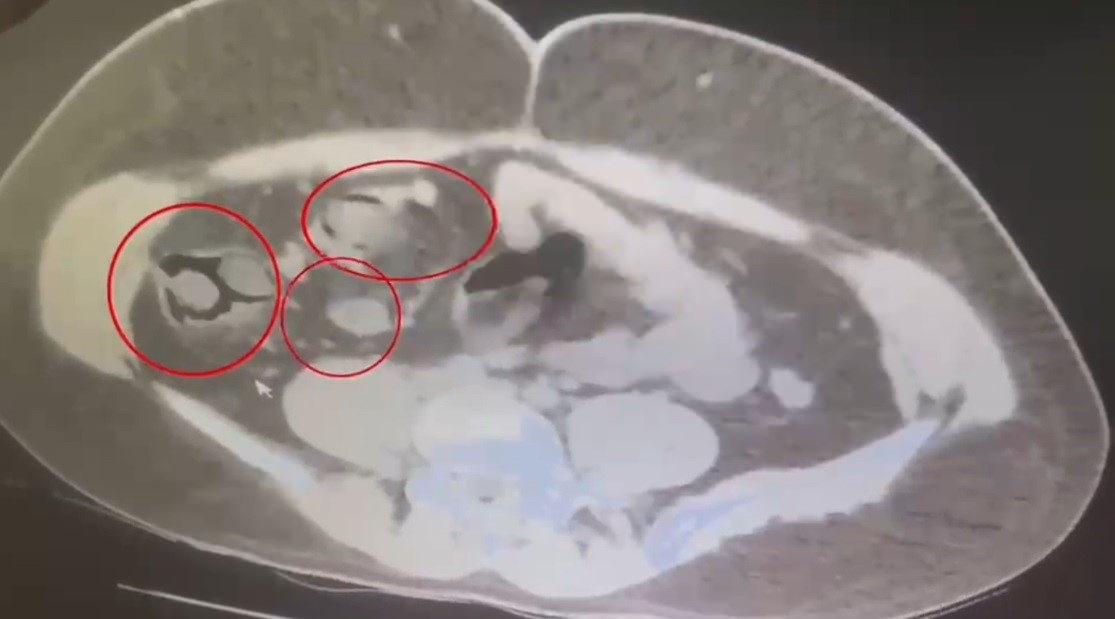 Kars'ta İranlı kuryenin midesinden 76 parça metamfetamin çıktı.