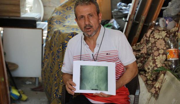 İş kazası ge&ccedil;irdi, ameliyat oldu, belinde pan&ccedil; unutuldu
