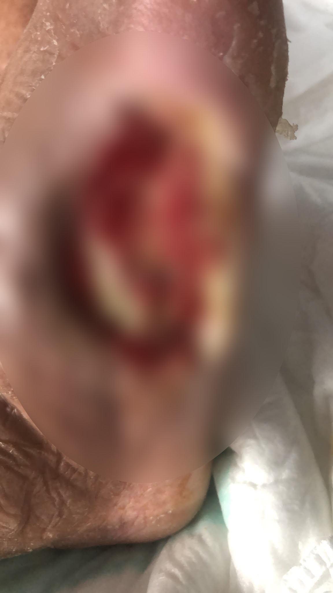 Ayağı kesilmek üzere olan emekli madenci, çözünebilir deri ile sağlığına kavuştu.