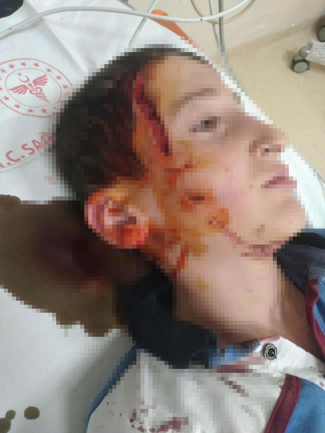 11 yaşında olan S.G. (14), köpek saldırısına uğradı. 